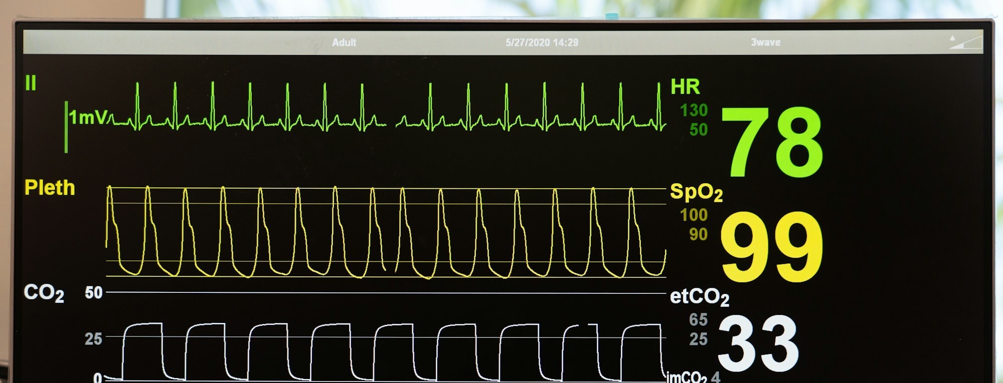 A bedside patient monitor streaming ECG, pulse oximetry, and capnography waveforms alongside heart rate, oxygen saturation, and respiratory rate
